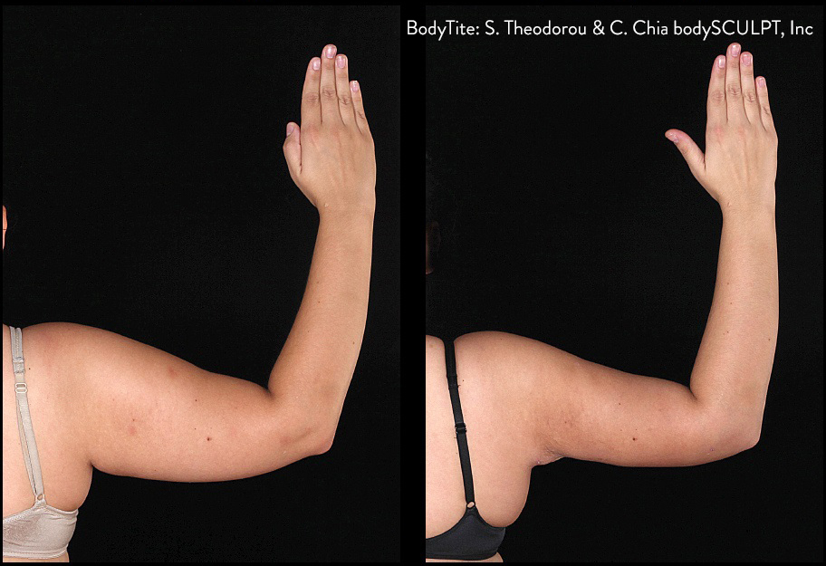 BodyTite Arms Before and After