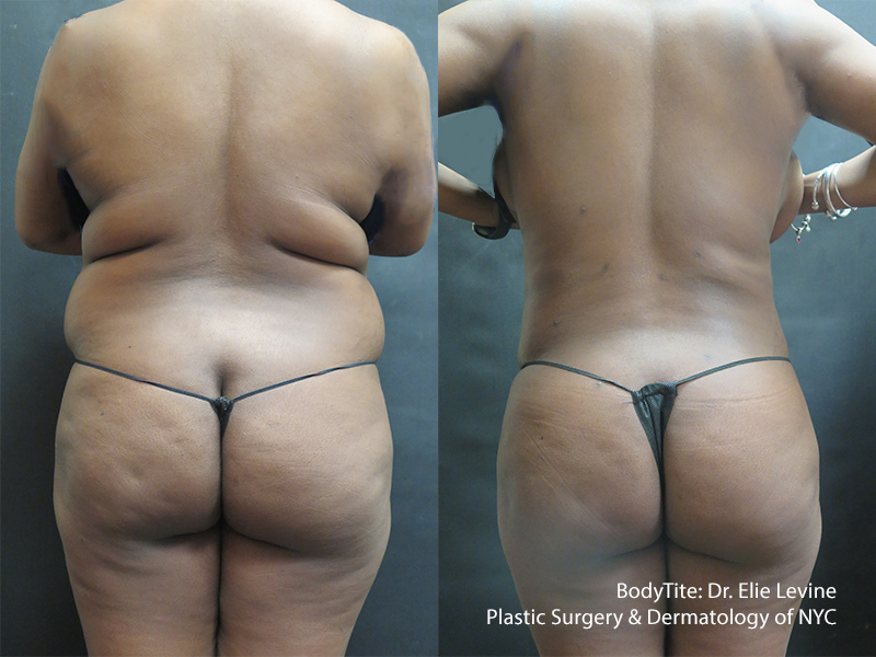 BodyTite: Back and Hips Before and After