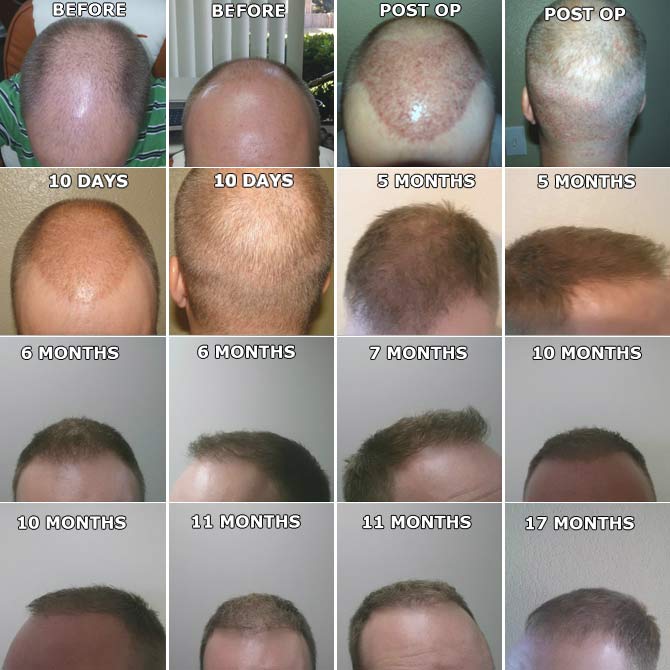 Hair Transplant in Cleveland