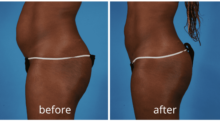 How Soon Will You See Results After Nonsurgical Body Contouring?