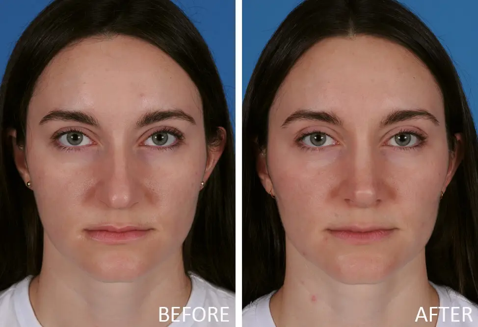 Before-and-after images of a female patient showcasing rhinoplasty results, highlighting facial symmetry and improved nasal contour, relevant to Dr. Bahman Guyuron's rhinoplasty gallery.