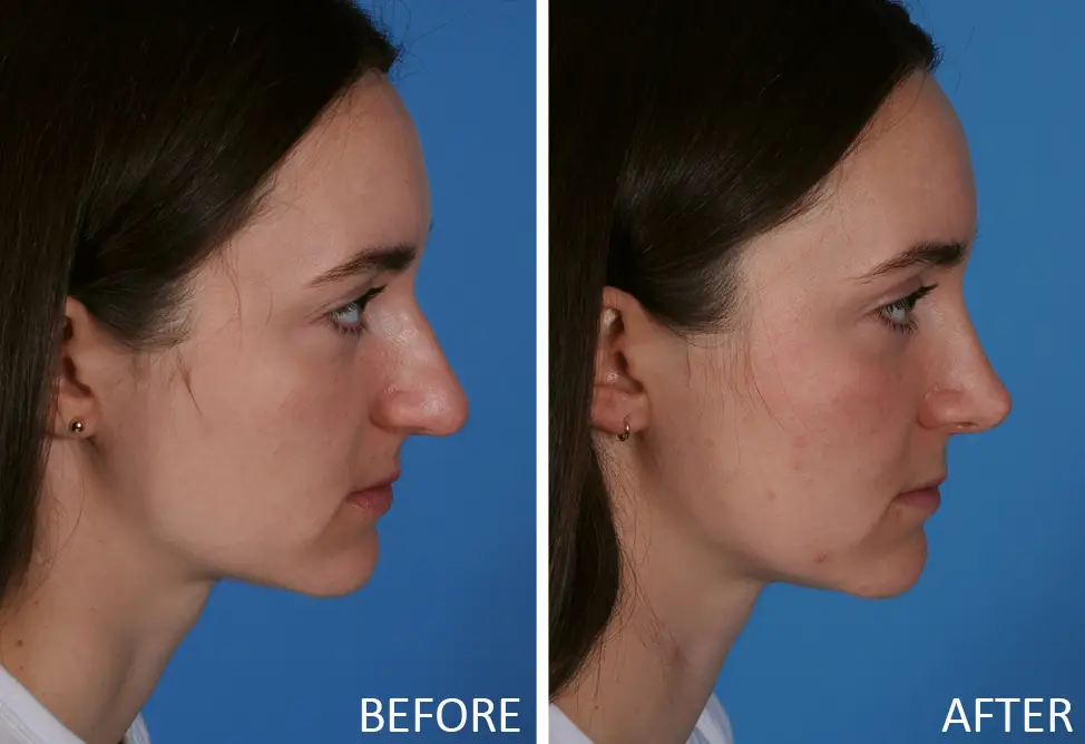 Before-and-after images of a female patient showcasing rhinoplasty results, highlighting profile changes in nose shape and facial contour, with a blue background.