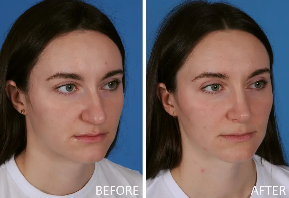Before-and-after images of a female patient showcasing rhinoplasty results, highlighting facial profile changes and improved nasal contours, presented in a gallery by Dr. Bahman Guyuron.