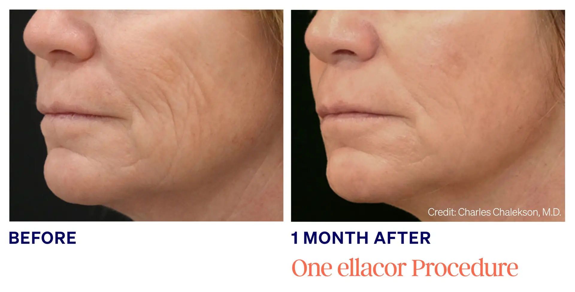 Chalekson-Female (1)