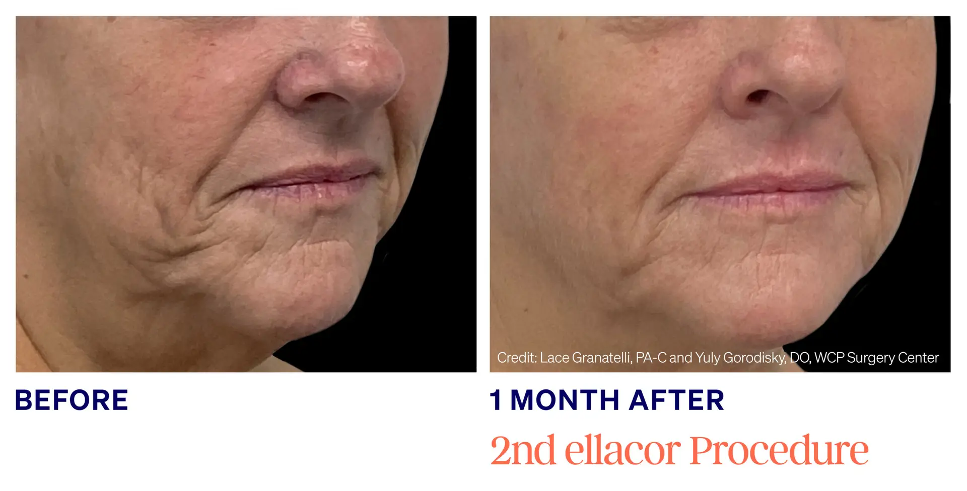 Gorodisky-Female-Side (1)